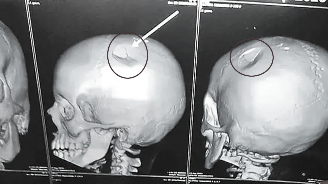 Teacher assaults student, causes skull fracture in AP