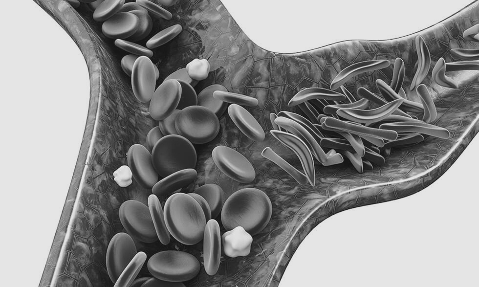 Chhattisgarh screens 1.65 crore people for sickle cell disease