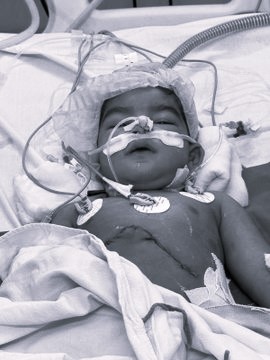 Osmania Sets New Standard as Rare Pediatric Liver Transplant Succeeds in Govt Hospital