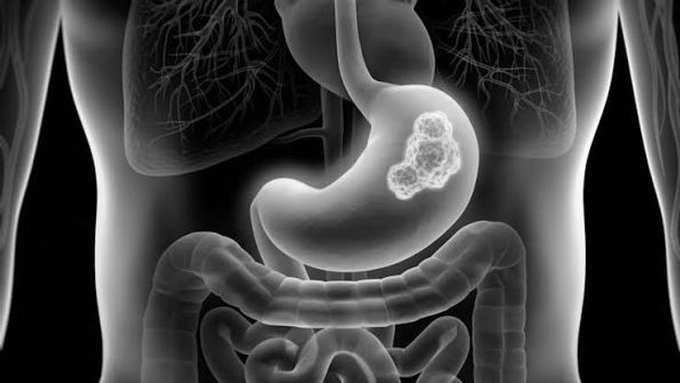 H. pylori Eradication Can Help Prevent Gastric Cancer, Says Nobel Laureate Barry Marshall